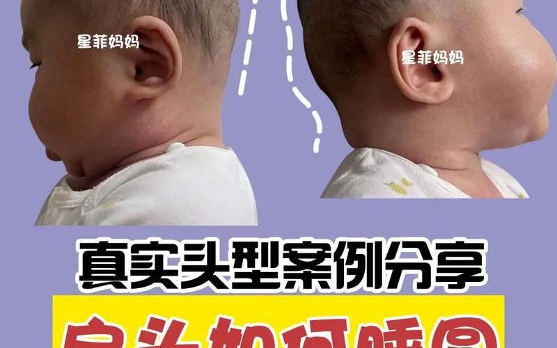 后脑勺圆还是扁是先天还是(后脑勺扁平是天生的吗)