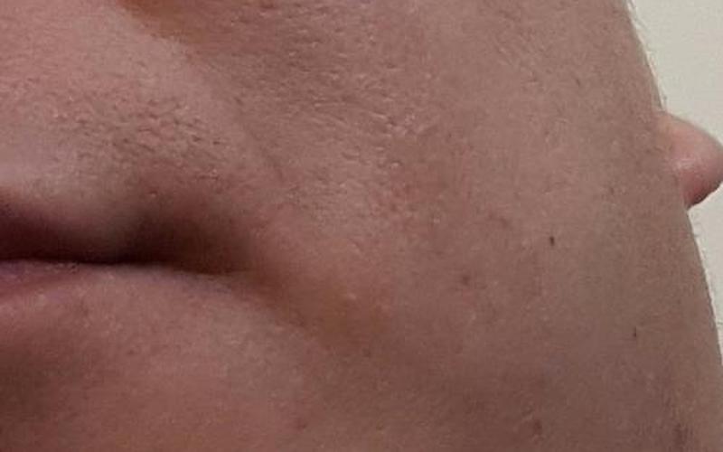 瘊子是激光好还是手术(瘊子手术切除用缝针吗)