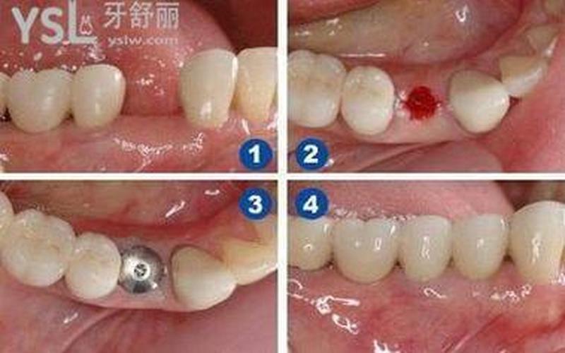 后槽牙拔掉了是镶牙还是种植(后槽牙掉了可以不补吗)
