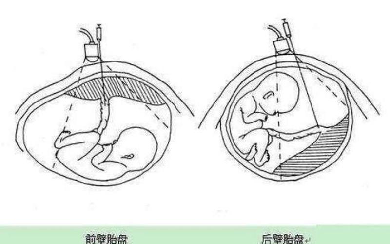 怀孕后壁是儿子还是女儿(后壁男孩多还是女孩多)