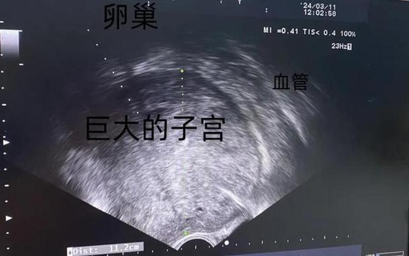 怀孕是做B超还是阴超好(孕检阴超和b超的区别)